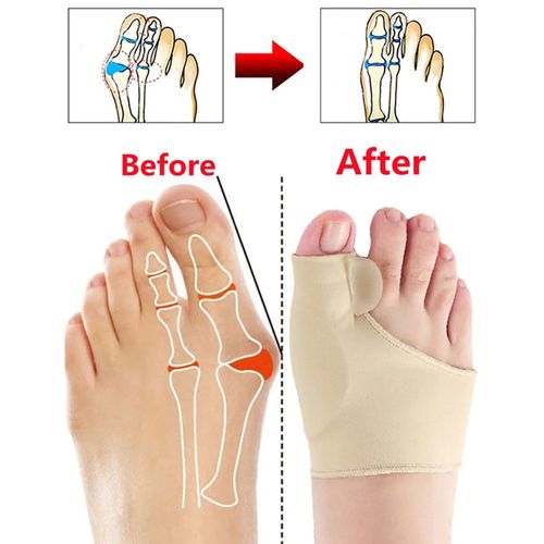 المصحح إبهام القدم السحري لإعوجاج الأصابع