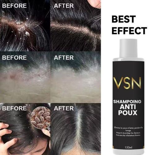 Shampoing Anti-Poux 150ml – Élimine les Poux et Lentes, Protection et Cheveux Doux