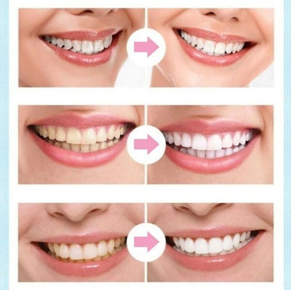 Stylo de Blanchiment Dentaire zaxx