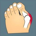 product_image_name-No Specified-2 Pcs Bunion Corrector-2