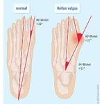 product_image_name-No Specified-2 Pcs Bunion Corrector-3