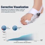 product_image_name-Generic-Correcteur d'oignon Feetix, Rotation Flexible à 180 Degrés Innovation-4