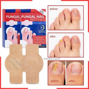 21PCS Patch anti-mycose des ongles imperméable,autocollants réparateurs pour les ongles des pieds,anti-infection,correction des ongles incarnés,soin des pied