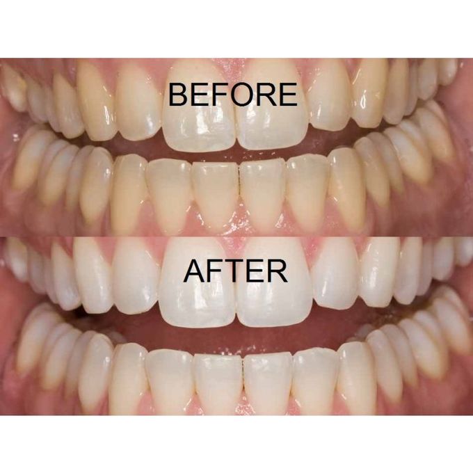 Teeth whitening opalescence 15